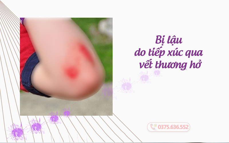 do tiếp xúc vết thương hở