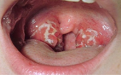 bệnh lậu ở miệng