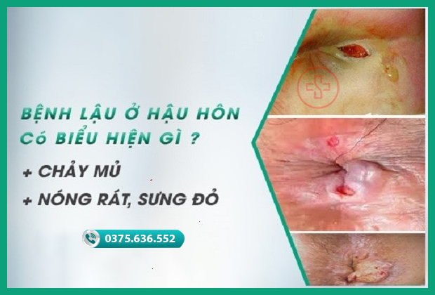 Lậu ở hậu môn