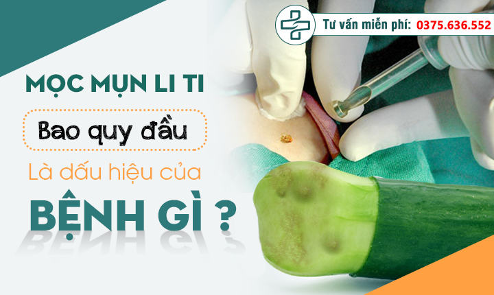 Mọc mụn li ti ở bao quy đầu là bệnh gì ?