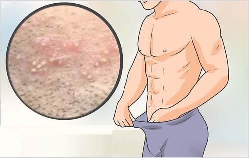 mụn rộp sinh dục