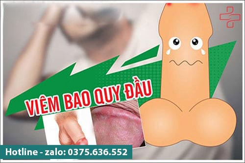 Viêm bao quy đầu