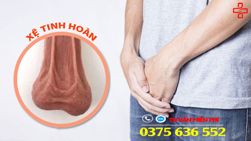 Xệ tinh hoàn - xệ bìu