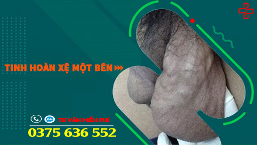 Cách chữa bìu xệ