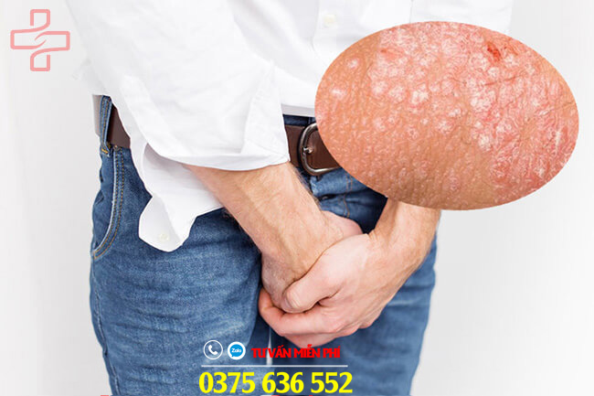 cách chữa ngứa rát ở bìu