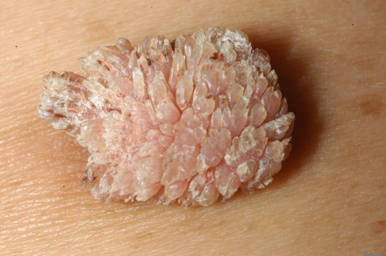 sùi mào gà