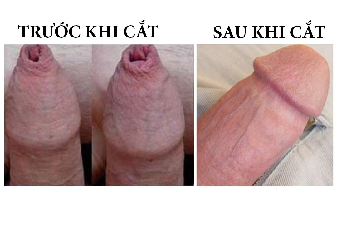 cắt bao quy đầu tại Đống Đa Hà Nội