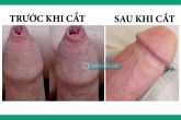 CẮT BAO QUY ĐẦU Ở THANH XUÂN HÀ NỘI