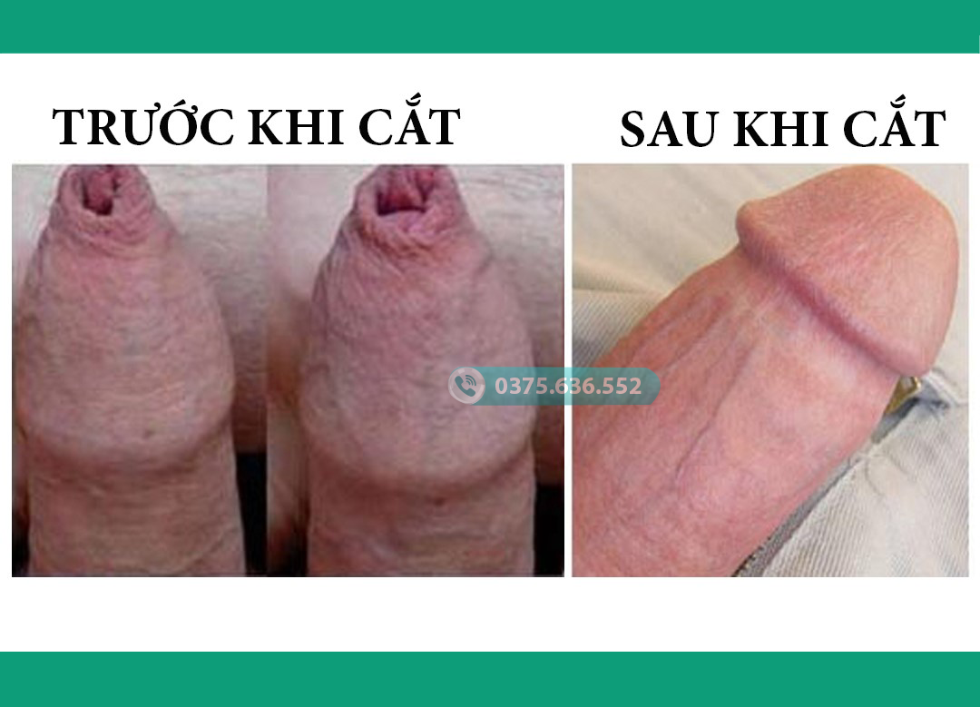 Cắt bao quy đầu ở Thanh Xuân Hà Nội