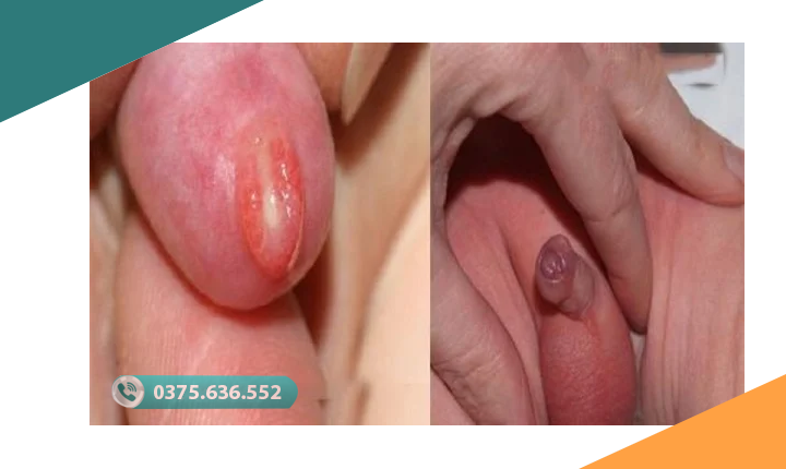 nong trẻ bị hẹp bao quy đầu